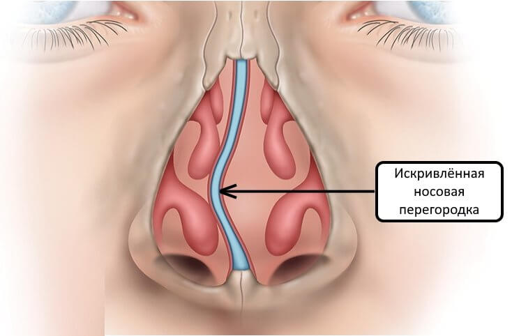 Septale Congestion Nasale Chronique : causes, diagnostic et traitement | Guide ...